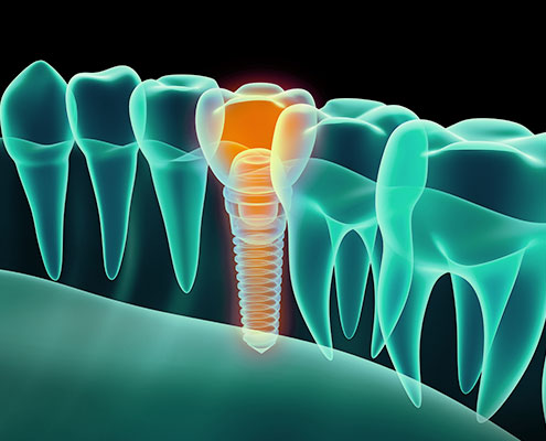 Implantaten, Implantologie, Tandarts Hoevelaken